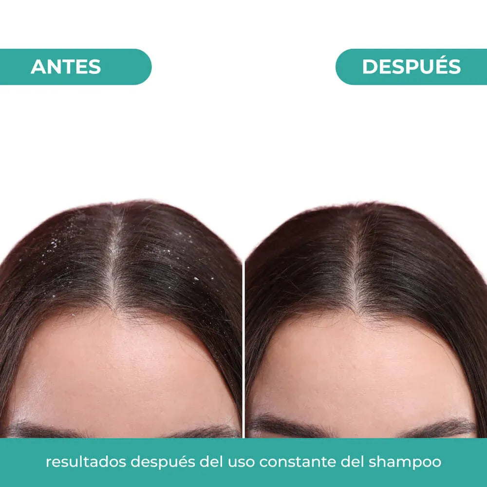 resultados-shampoo-control-caspa-naissant